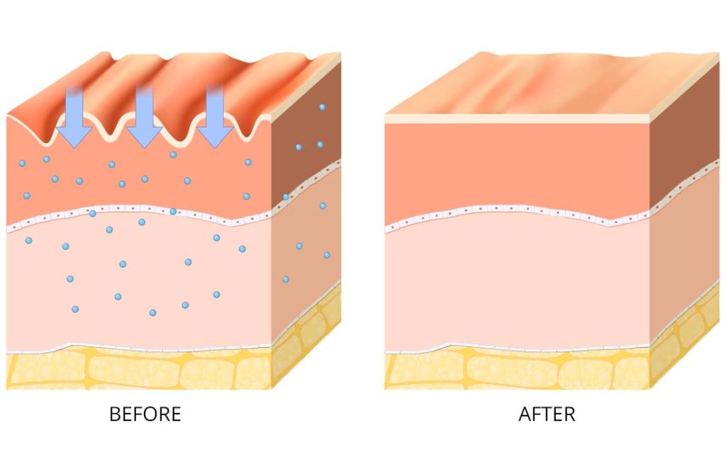 Illustration showing moisture penetrating layers of human skin