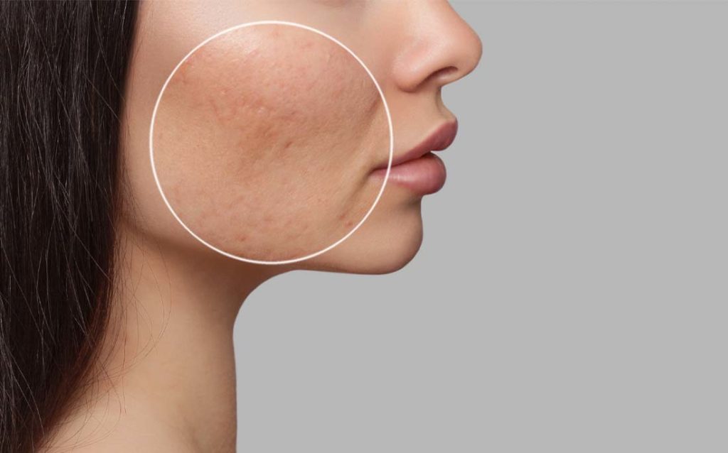 Close-up photo showing the kind of acne scars that Vitamin C serum can help to heal