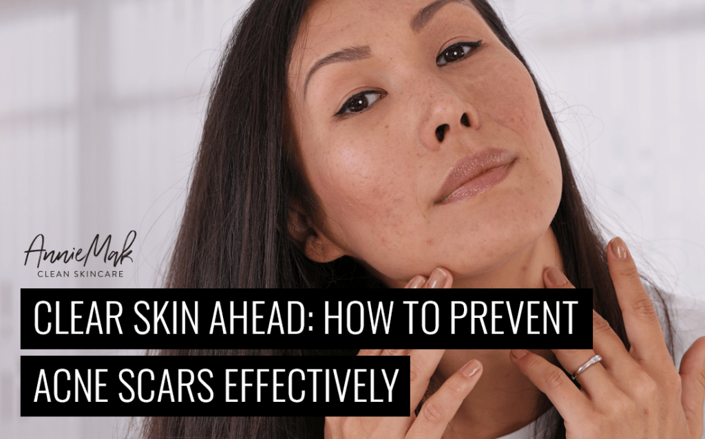 Clean Skin Ahead How To Prevent Acne Scars Effectively