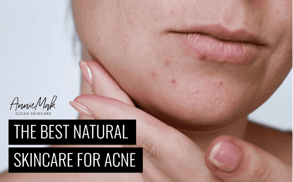 The Best Natural Skincare for Acne